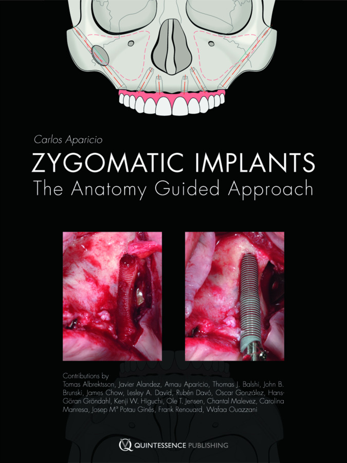 Zygomatic Implants The Anatomy Guided Approach Wydawnictwo Kwintesencja